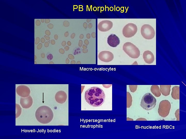 PB Morphology Macro-ovalocytes Howell-Jolly bodies Hypersegmented neutrophils Bi-nucleated RBCs 
