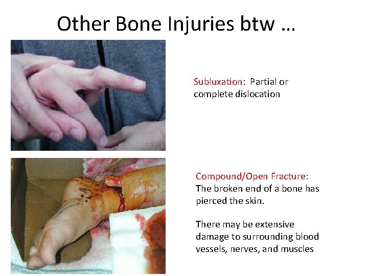 Other Bone Injuries btw … Subluxation: Partial or complete dislocation Compound/Open Fracture: The broken