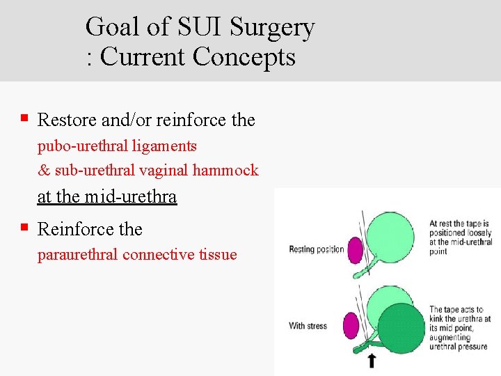 Goal of SUI Surgery : Current Concepts § Restore and/or reinforce the pubo-urethral ligaments