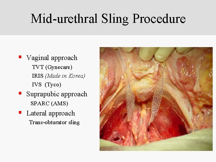 Mid-urethral Sling Procedure § Vaginal approach TVT (Gynecare) IRIS (Made in Korea) IVS (Tyco)