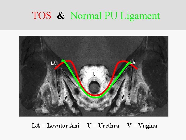 TOS & Normal PU Ligament LA = Levator Ani U = Urethra V =