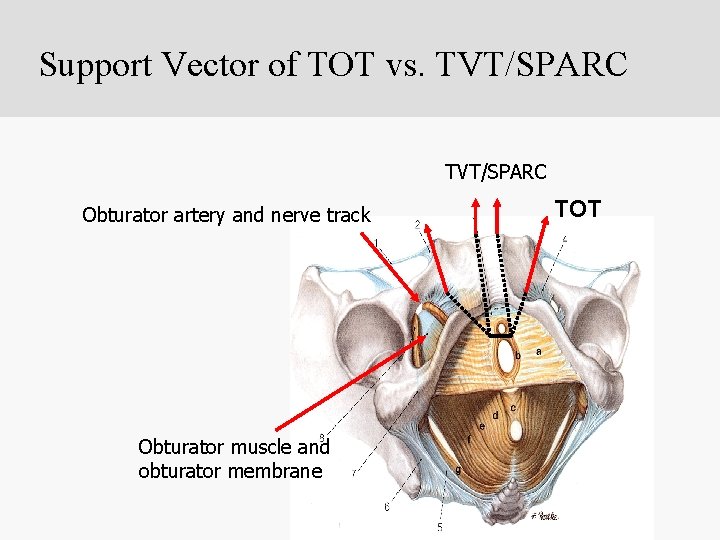 Support Vector of TOT vs. TVT/SPARC Obturator artery and nerve track Obturator muscle and