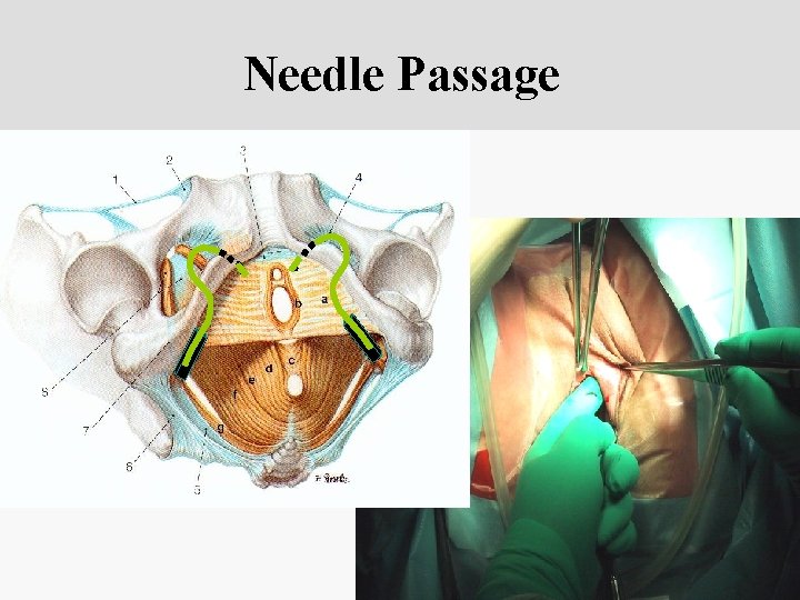 Needle Passage 