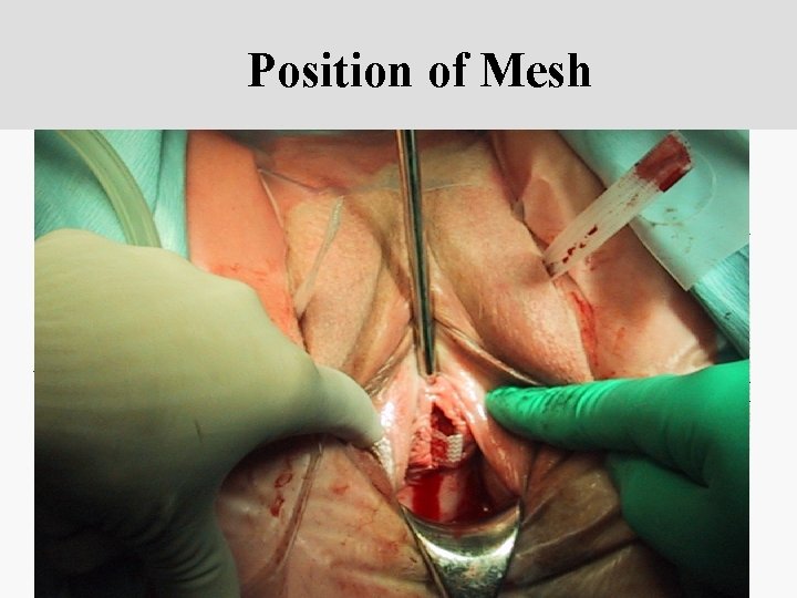 Position of Mesh clitoris urethral meatus 