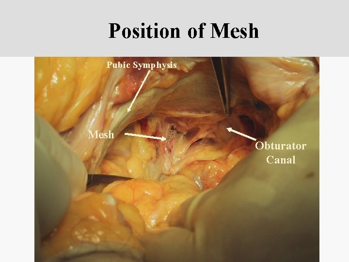 Position of Mesh Pubic Symphysis Mesh Obturator Canal 
