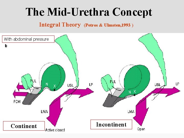 The Mid-Urethra Concept Integral Theory (Petros & Ulmsten, 1993 ) With abdominal pressure Continent