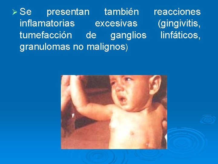 Ø Se presentan también reacciones inflamatorias excesivas (gingivitis, tumefacción de ganglios linfáticos, granulomas no