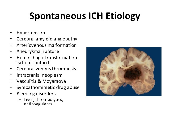 Spontaneous ICH Etiology • • • Hypertension Cerebral amyloid angiopathy Arteriovenous malformation Aneurysmal rupture