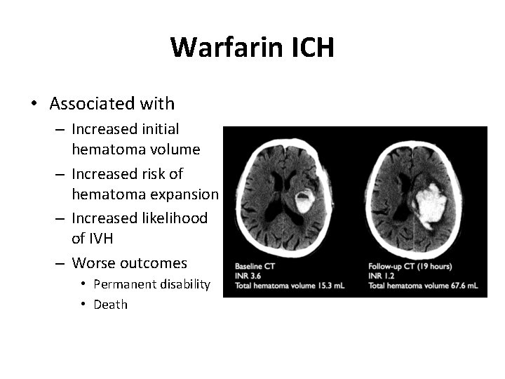 Warfarin ICH • Associated with – Increased initial hematoma volume – Increased risk of