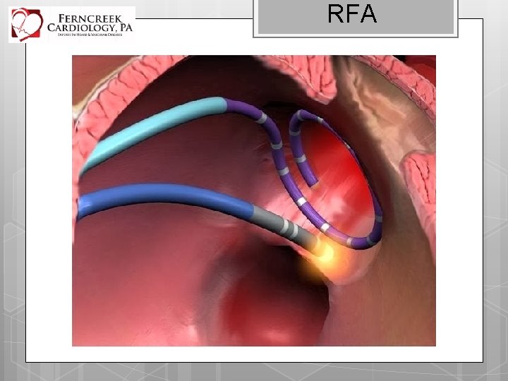 RFA Radio. Frequency Ablation – RFA Vs. Cryoablation 
