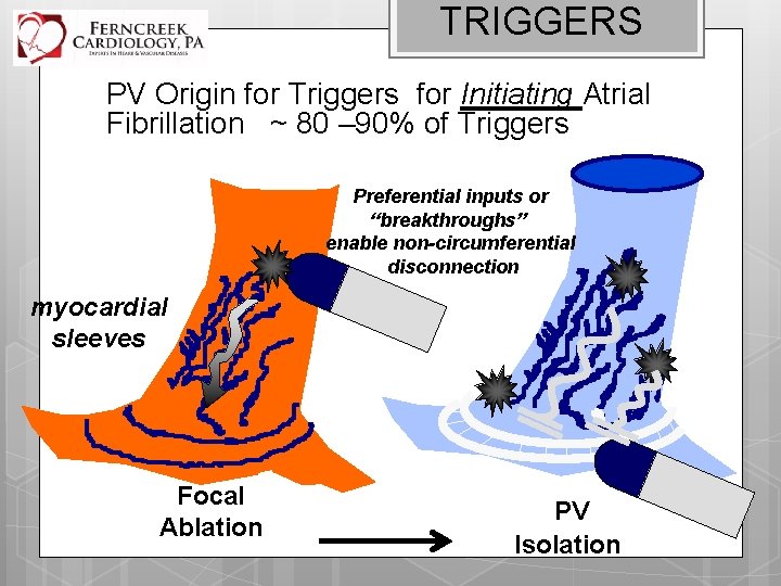 TRIGGERS PV Origin for Triggers for Initiating Atrial Fibrillation ~ 80 – 90% of