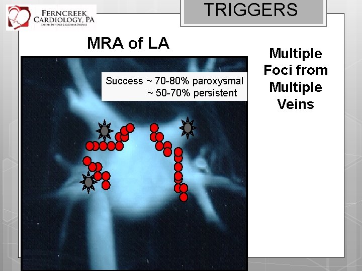 TRIGGERS MRA of LA Success ~ 70 -80% paroxysmal ~ 50 -70% persistent Multiple