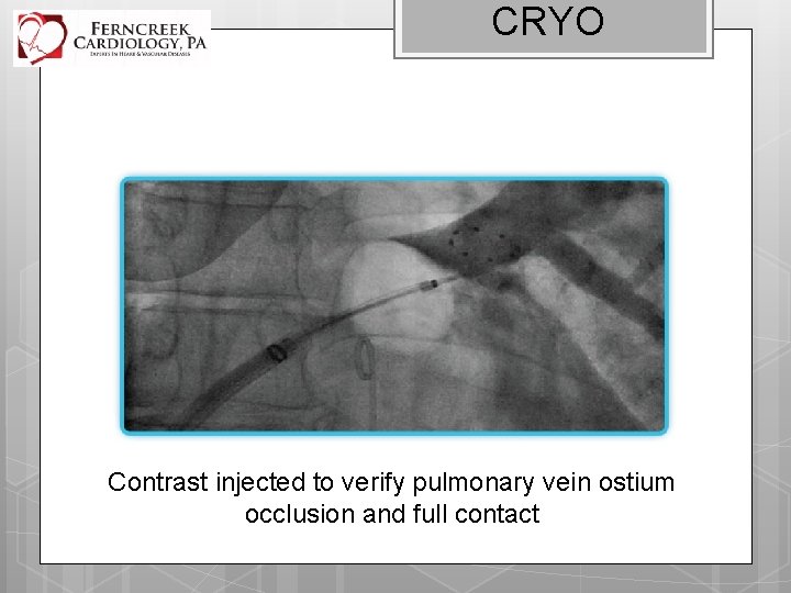 CRYO Contrast injected to verify pulmonary vein ostium occlusion and full contact 