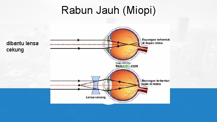 Rabun Jauh (Miopi) dibantu lensa cekung 