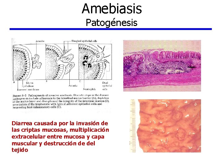 Amebiasis Patogénesis Diarrea causada por la invasión de las criptas mucosas, multiplicación extracelular entre