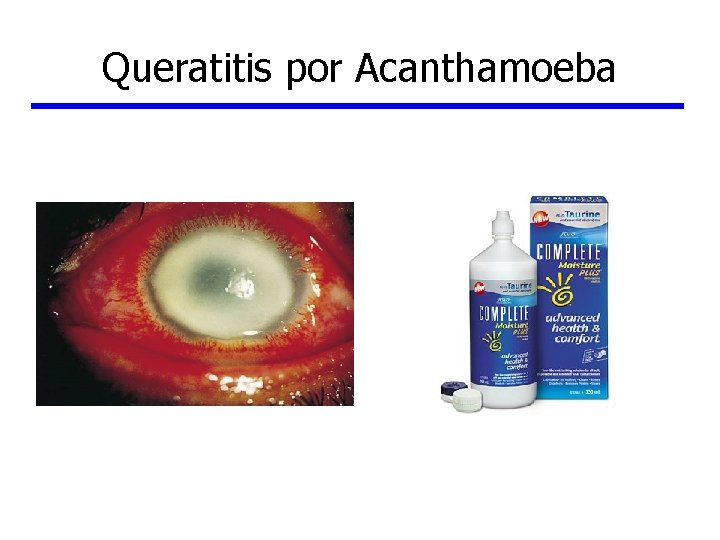 Queratitis por Acanthamoeba 