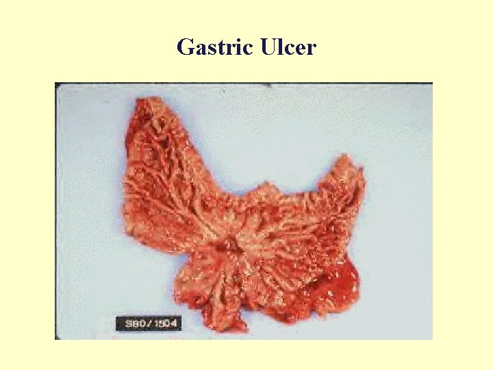 Gastric Ulcer 