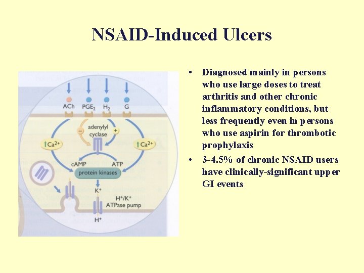 NSAID-Induced Ulcers • Diagnosed mainly in persons who use large doses to treat arthritis