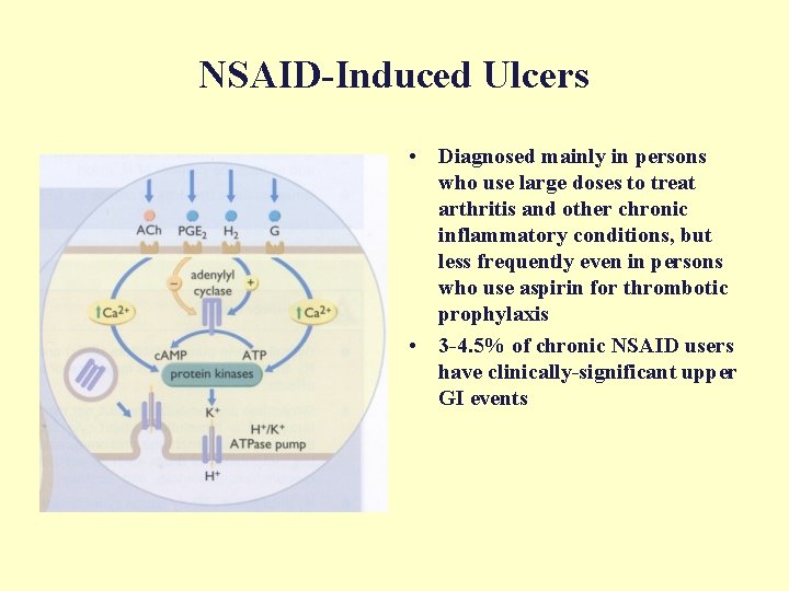 NSAID-Induced Ulcers • Diagnosed mainly in persons who use large doses to treat arthritis