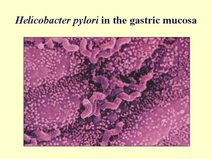 Helicobacter pylori in the gastric mucosa 