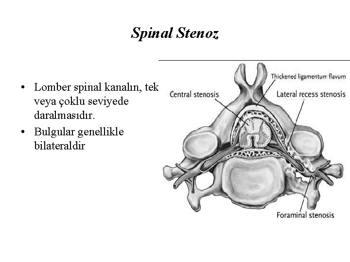 Spinal Stenoz • Lomber spinal kanalın, tek veya çoklu seviyede daralmasıdır. • Bulgular genellikle