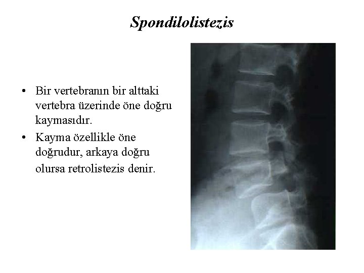 Spondilolistezis • Bir vertebranın bir alttaki vertebra üzerinde öne doğru kaymasıdır. • Kayma özellikle