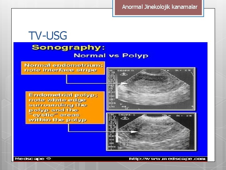 Anormal Jinekolojik kanamalar TV-USG 