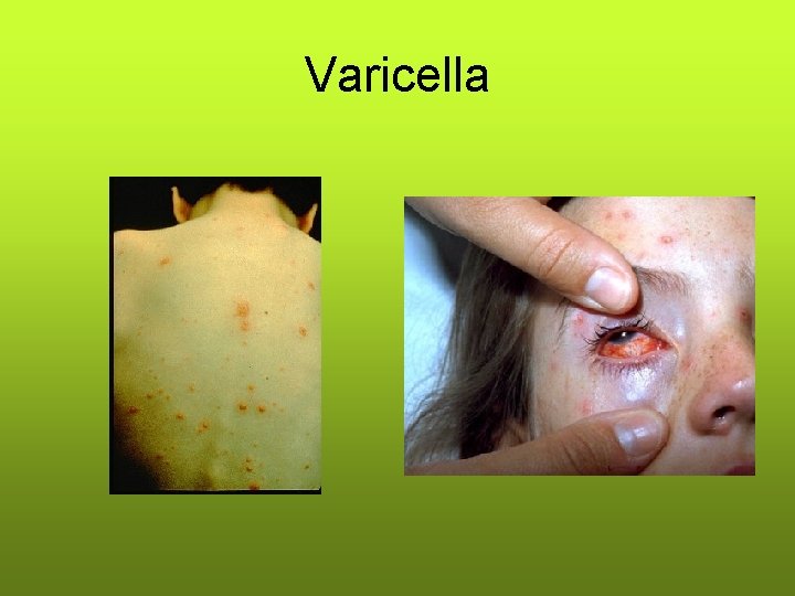 Varicella Varicella