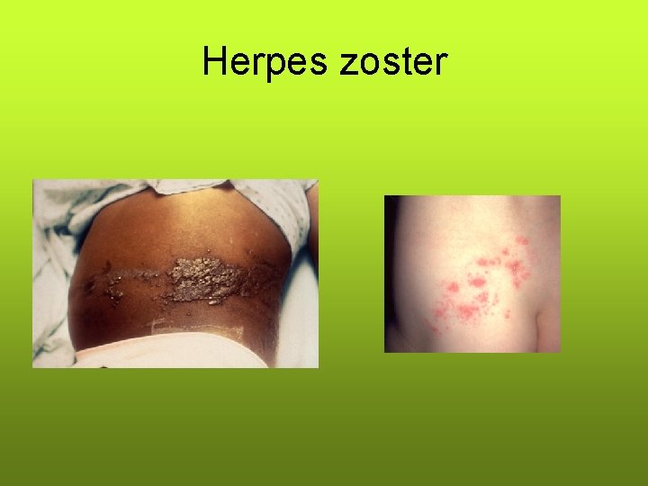 Herpes zoster Herpes zoster