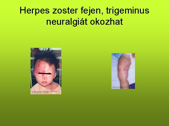 Herpes zoster fejen, trigeminus neuralgiát okozhat 