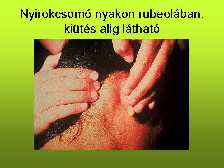 Nyirokcsomó nyakon rubeolában, kiütés alig látható Nyirokcsomó nyakon rubeolában, kiütés alig látható