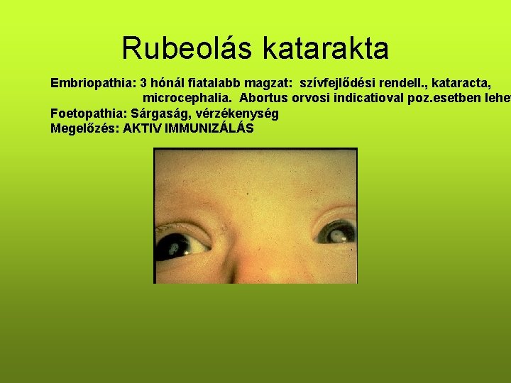 Rubeolás katarakta Embriopathia: 3 hónál fiatalabb magzat: szívfejlődési rendell. , kataracta, microcephalia. Abortus orvosi Rubeolás katarakta Embriopathia: 3 hónál fiatalabb magzat: szívfejlődési rendell. , kataracta, microcephalia. Abortus orvosi