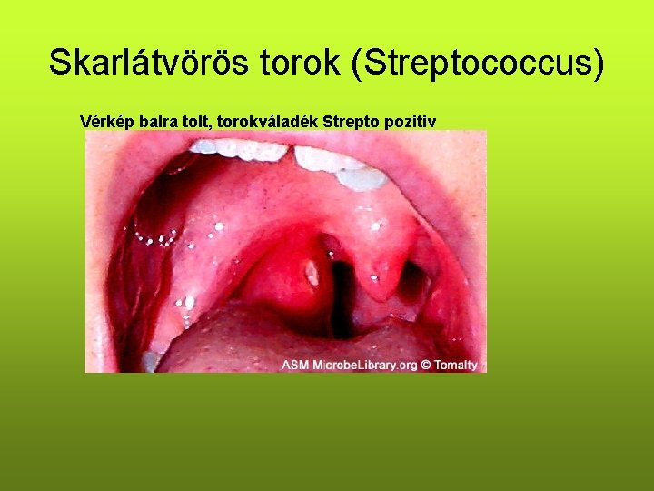Skarlátvörös torok (Streptococcus) Vérkép balra tolt, torokváladék Strepto pozitiv 