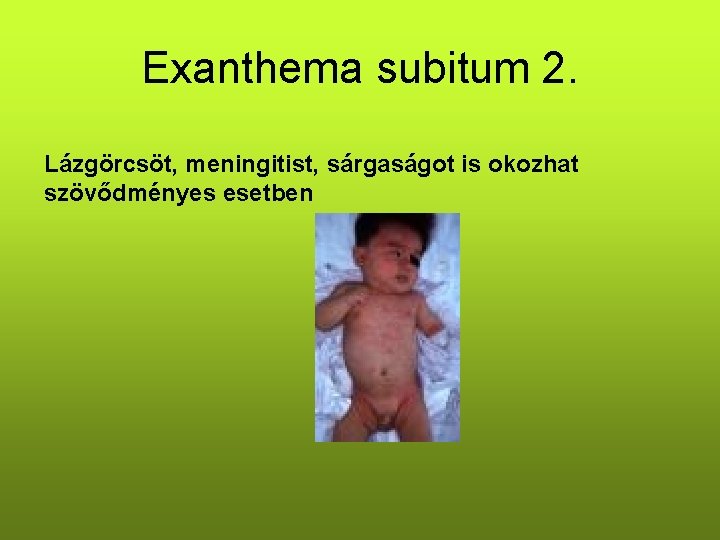 Exanthema subitum 2. Lázgörcsöt, meningitist, sárgaságot is okozhat szövődményes esetben 