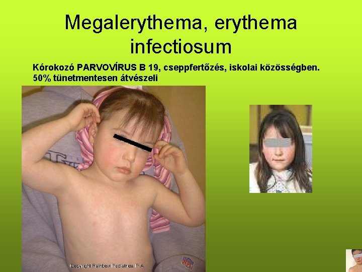Megalerythema, erythema infectiosum Kórokozó PARVOVÍRUS B 19, cseppfertőzés, iskolai közösségben. 50% tünetmentesen átvészeli 