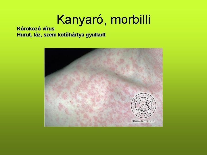 Kanyaró, morbilli Kórokozó vírus Hurut, láz, szem kötőhártya gyulladt 