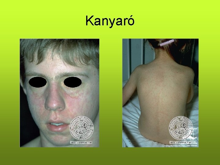 Kanyaró Kanyaró