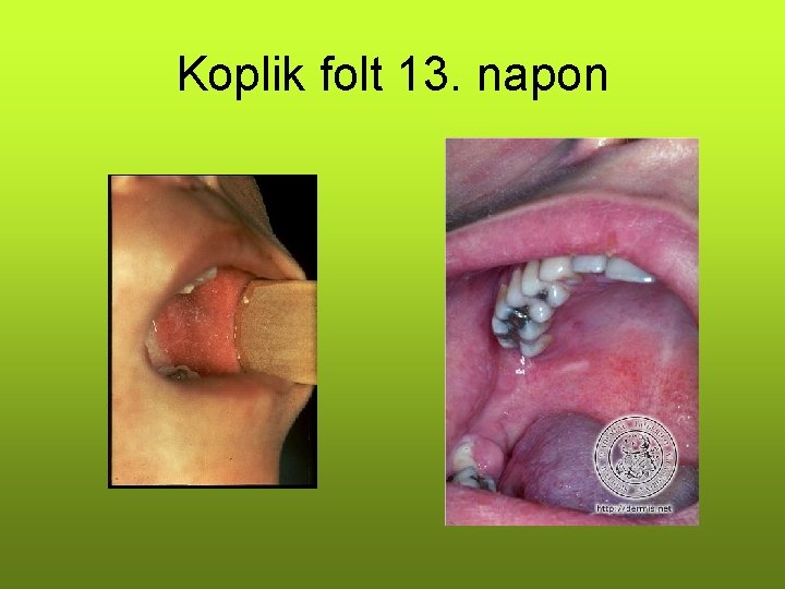Koplik folt 13. napon Koplik folt 13. napon