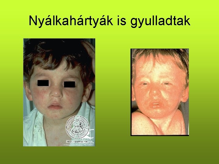 Nyálkahártyák is gyulladtak Nyálkahártyák is gyulladtak