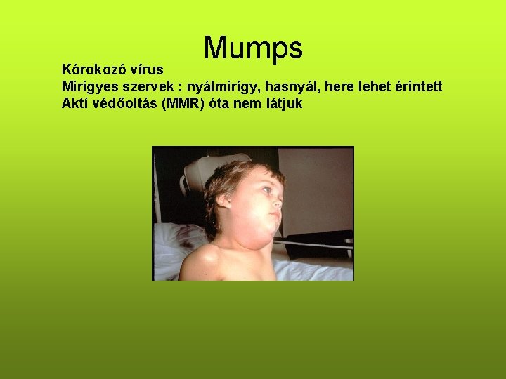 Mumps Kórokozó vírus Mirigyes szervek : nyálmirígy, hasnyál, here lehet érintett Aktí védőoltás (MMR) Mumps Kórokozó vírus Mirigyes szervek : nyálmirígy, hasnyál, here lehet érintett Aktí védőoltás (MMR)