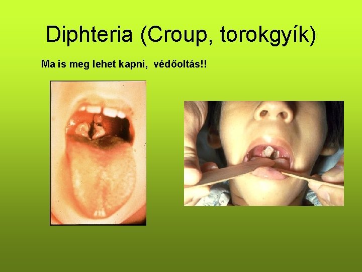 Diphteria (Croup, torokgyík) Ma is meg lehet kapni, védőoltás!! Diphteria (Croup, torokgyík) Ma is meg lehet kapni, védőoltás!!