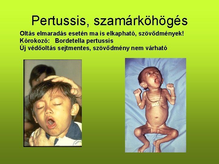 Pertussis, szamárköhögés Oltás elmaradás esetén ma is elkapható, szövődmények! Kórokozó: Bordetella pertussis Új védőoltás Pertussis, szamárköhögés Oltás elmaradás esetén ma is elkapható, szövődmények! Kórokozó: Bordetella pertussis Új védőoltás
