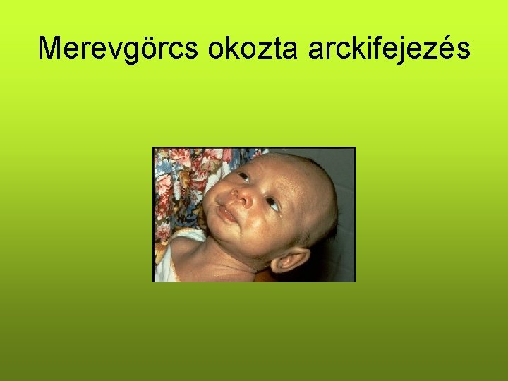 Merevgörcs okozta arckifejezés 