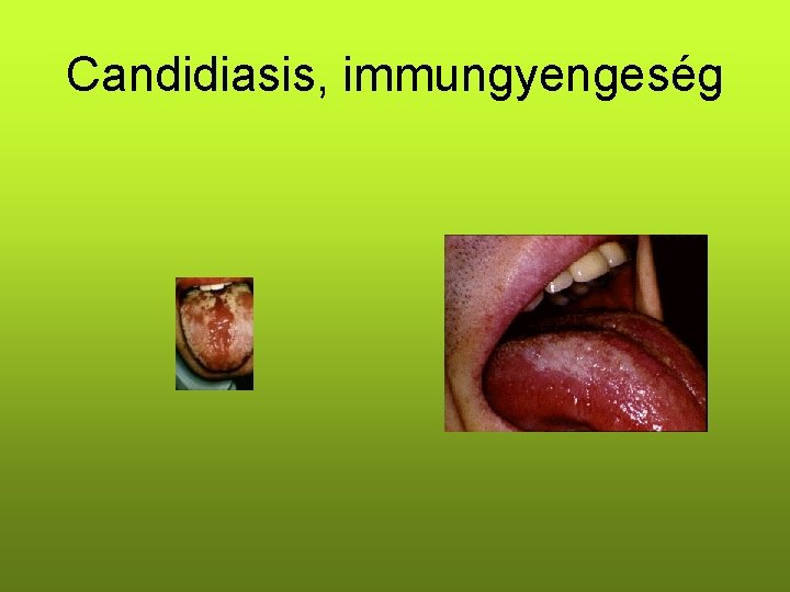 Candidiasis, immungyengeség 