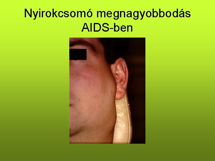 Nyirokcsomó megnagyobbodás AIDS-ben Nyirokcsomó megnagyobbodás AIDS-ben