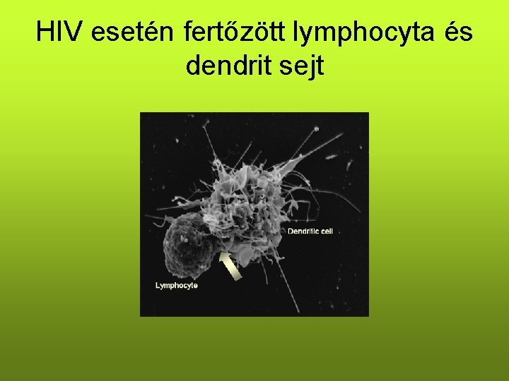 HIV esetén fertőzött lymphocyta és dendrit sejt HIV esetén fertőzött lymphocyta és dendrit sejt