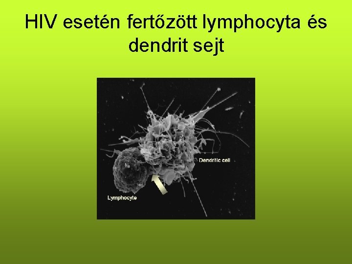 HIV esetén fertőzött lymphocyta és dendrit sejt 