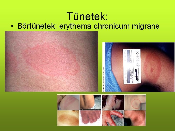 Tünetek: • Bőrtünetek: erythema chronicum migrans 