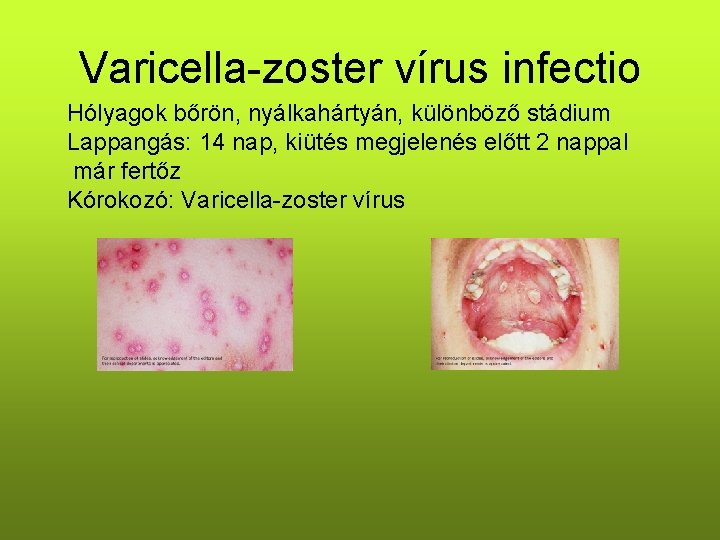 Varicella-zoster vírus infectio Hólyagok bőrön, nyálkahártyán, különböző stádium Lappangás: 14 nap, kiütés megjelenés előtt