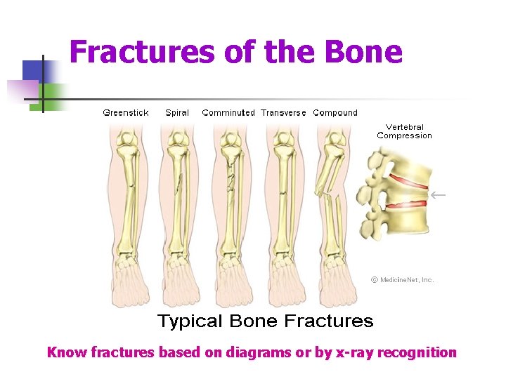 Fractures of the Bone Know fractures based on diagrams or by x-ray recognition 